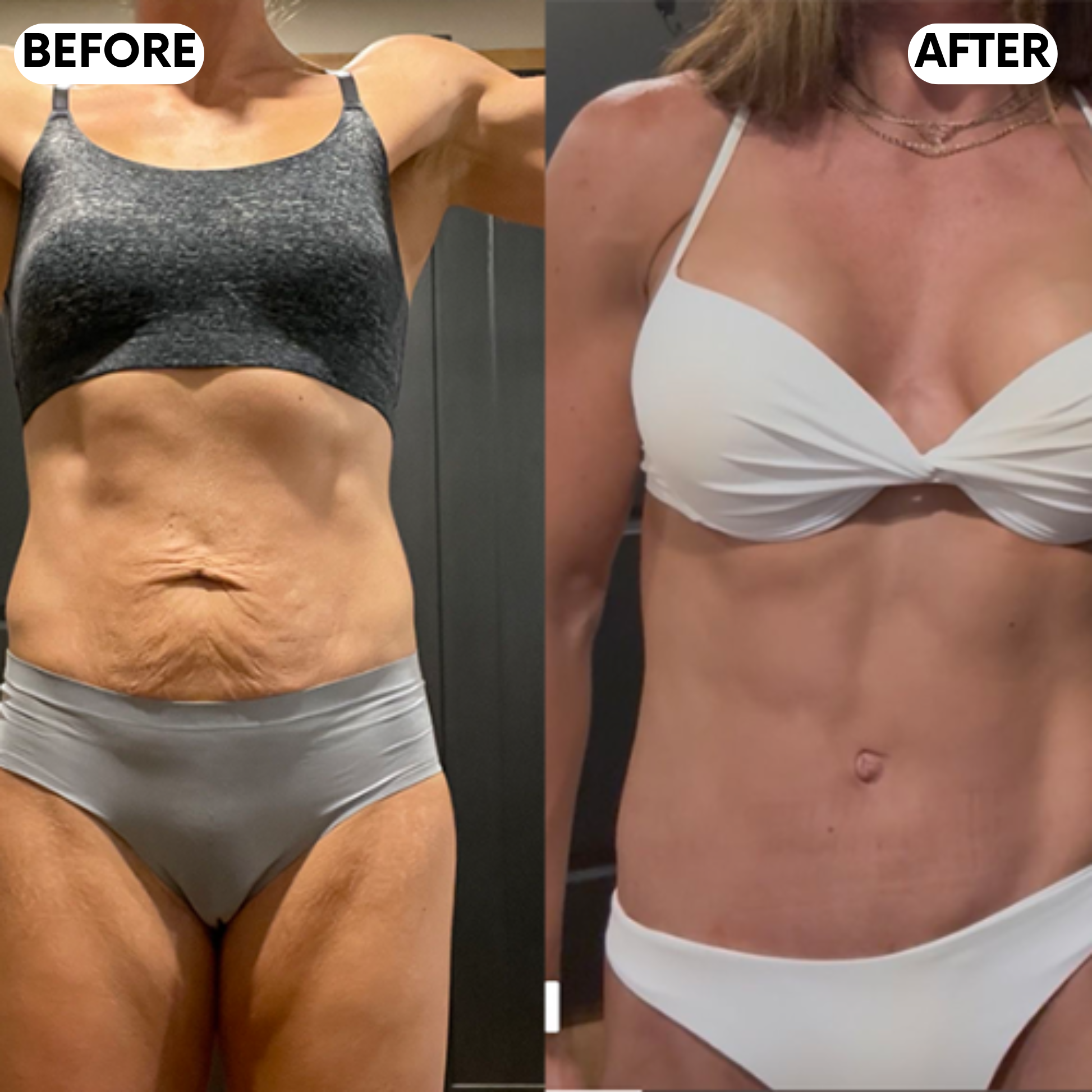 Elanaya® RedeFine Pro