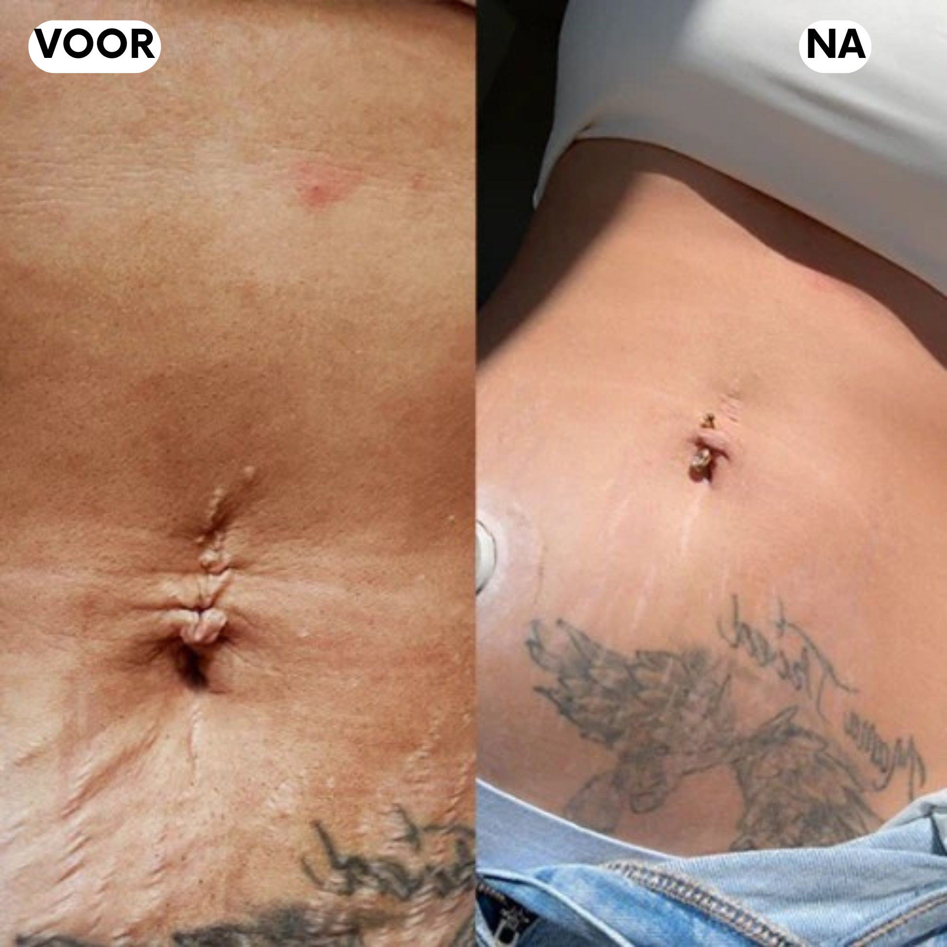 Elanaya® - LumenoLift+